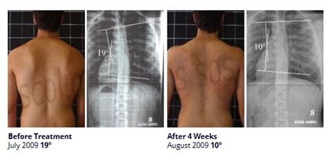 scoliosis cobb angle 15 degrees